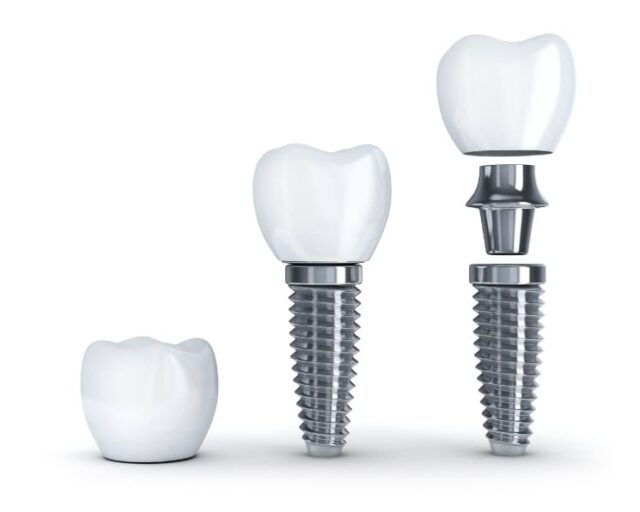 Implantologia dentystyczna